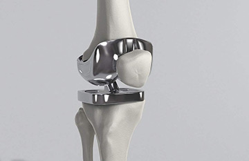 人工膝关节置换术后的保护